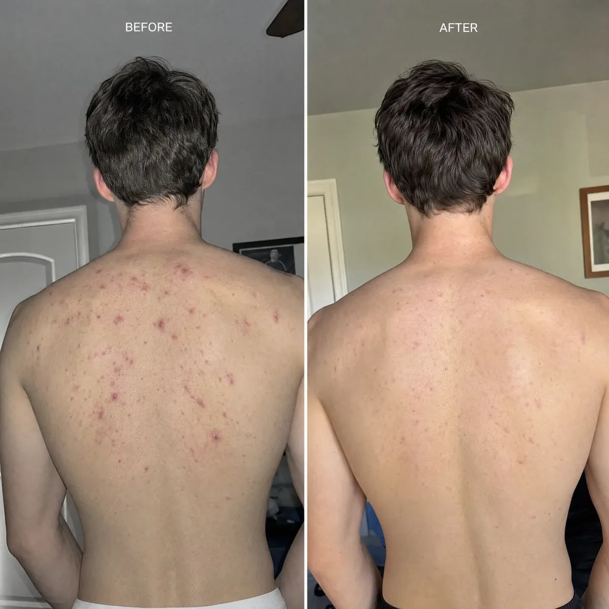 Before and after: the same back, breakouts cleared
